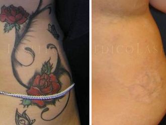 Eliminación de tatuajes - 624884