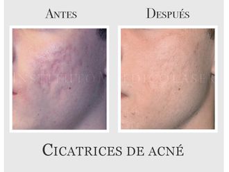 Tratamiento antiacné - 635072