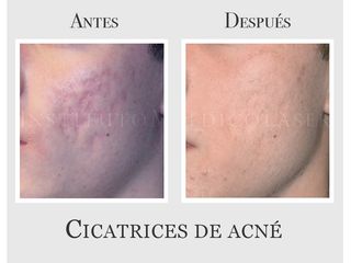 Cicatrices de acné, antes y después