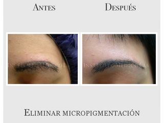 Eliminación de micropigmentación en cejas