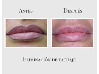 Eliminación de micropigmentación en labios