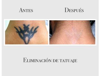 Eliminación de tatuajes - 635076