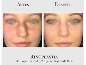 Rinoplastia - 639356