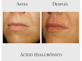Perfilado de labios con ácido hialurónico