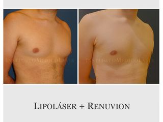 Definir pectorales con Lipo + Renuvion