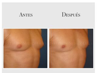 Tratamiento de la ginecomastia, antes y después