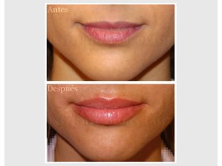 Ácido hialurónico en labios, antes y después