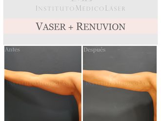 Lipo Vaser - 644407