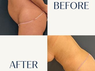 Liposucción antes y después - 880810
