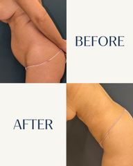Liposucción asistida por Vaser - IML CLINIC