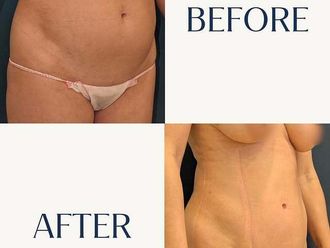 Lipo Vaser antes y después - 880811