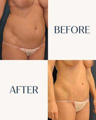 Lipo Vaser - IML CLINIC