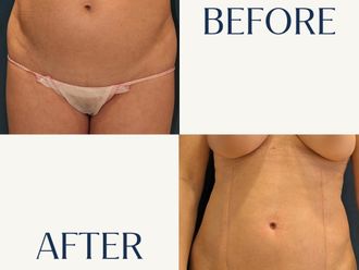 Lipo Vaser antes y después - 880812