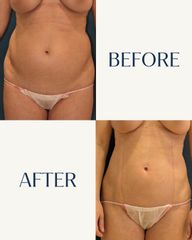 Lipo Vaser en abdomen - IML CLINIC