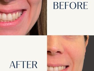 Rejuvenecimiento facial antes y después - 880813