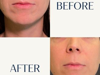 Rejuvenecimiento facial antes y después - 880814