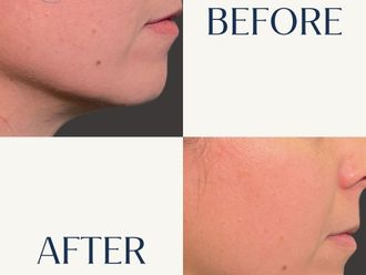 Rejuvenecimiento facial antes y después - 880815