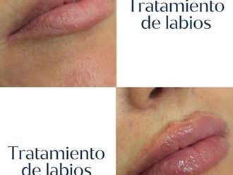 Aumento labios antes y después - 880872