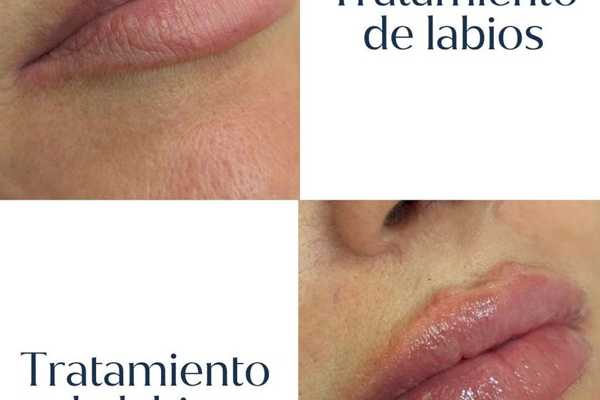 Aumento labios antes y después - 880872