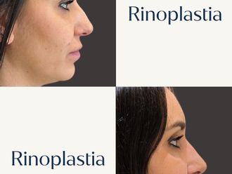 Rinoplastia antes y después - 880873