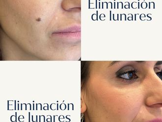 Lunares antes y después - 880874
