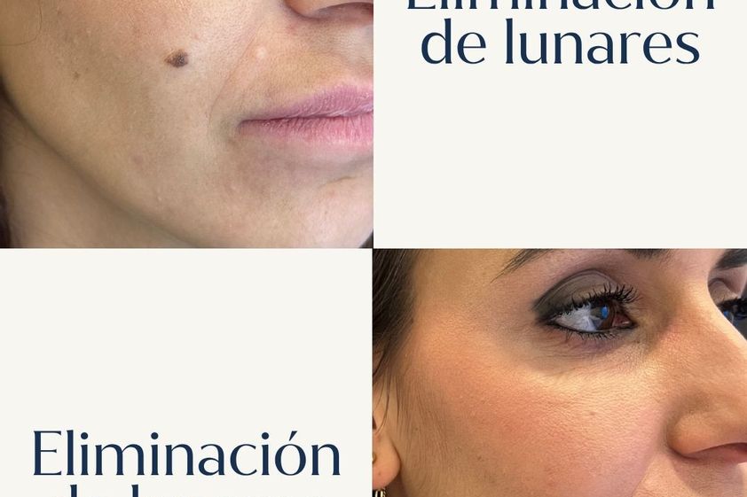 Lunares antes y después - 880874