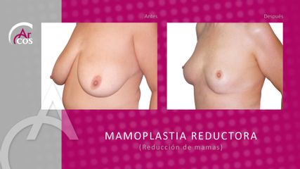 Antes y después Reducción mamas