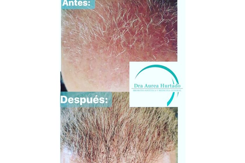 Tratamiento capilar antes y después - 661604