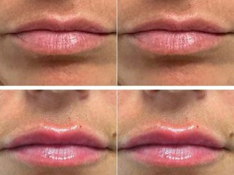 Aumento labios antes y después - 871666