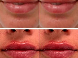 Aumento labios antes y después - 871667