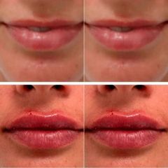 Aumento de labios - Clinicas Came Cartagena