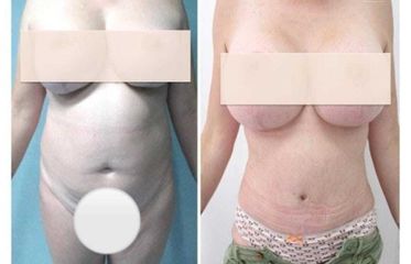 Abdominoplastia