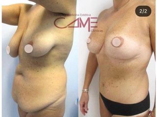 Abdominoplastia