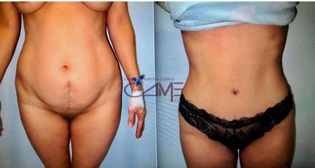 Abdominoplastia