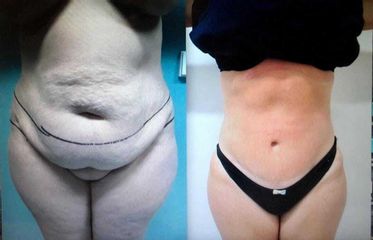 Abdominoplastia