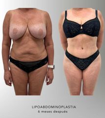 Abdominoplastia