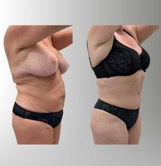 Abdominoplastia
