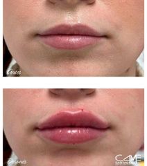 Aumento de labios