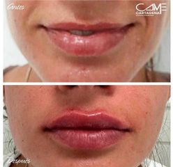 Aumento de labios