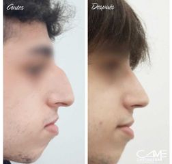 Rinoplastia