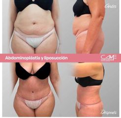 Abdominoplastia y  Liposucción