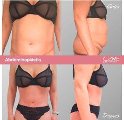 Abdominoplastia