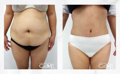 Abdominoplastia