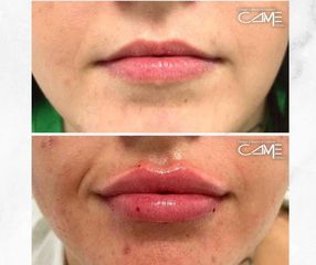 Aumento de labios