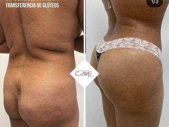 Aumento glúteos antes y después - 875358