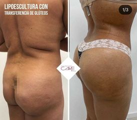 Aumento de glúteos