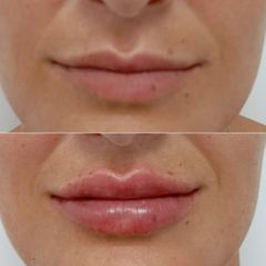 Clinicas Came Cartagena - Aumento de labios