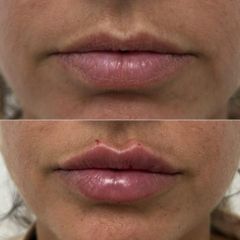 Clinicas Came Cartagena - Aumento de labios
