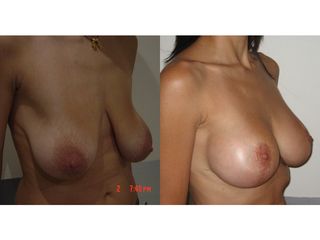 Mastopexia - Dra. Fabiola De Haro Guerrero