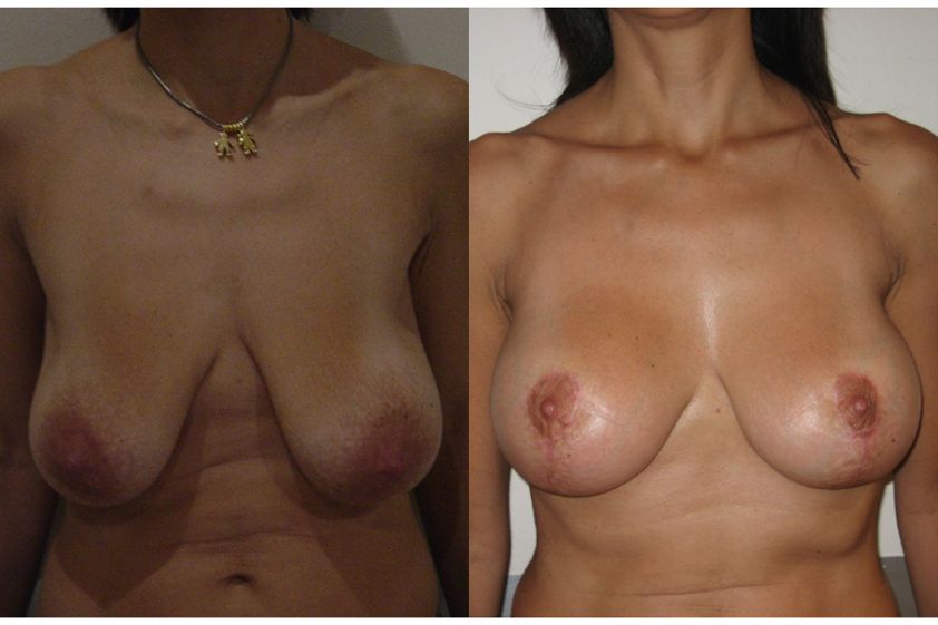 Mastopexia antes y después - 737588